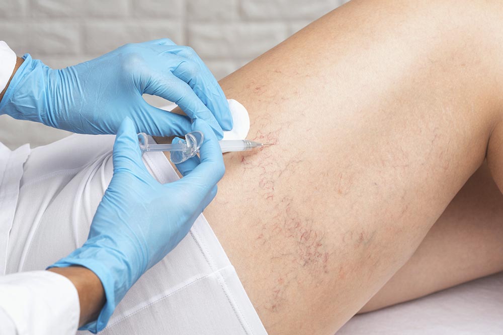ELIMINACIÓN DE VARICES: